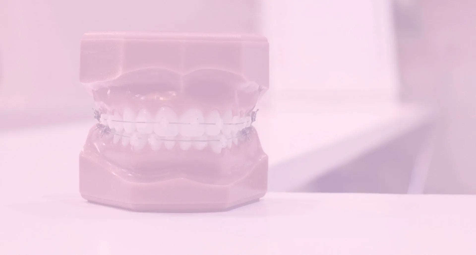 Veneers in Delhi: The Complete Guide to Your Dream Smile