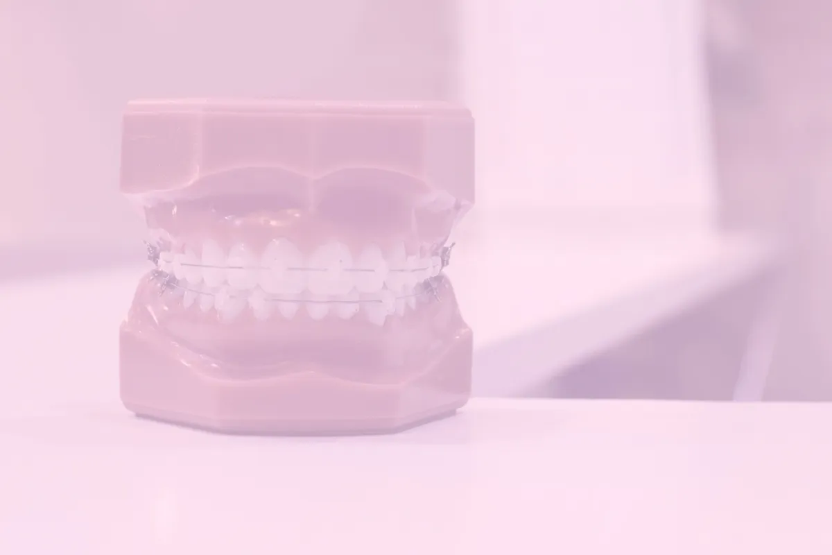 Dental braces model