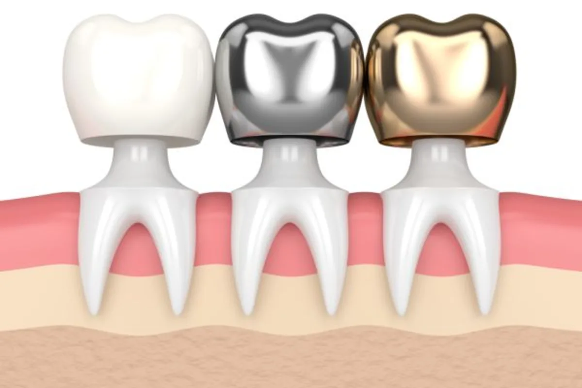 Illustration comparing ceramic, metal and gold dental crowns