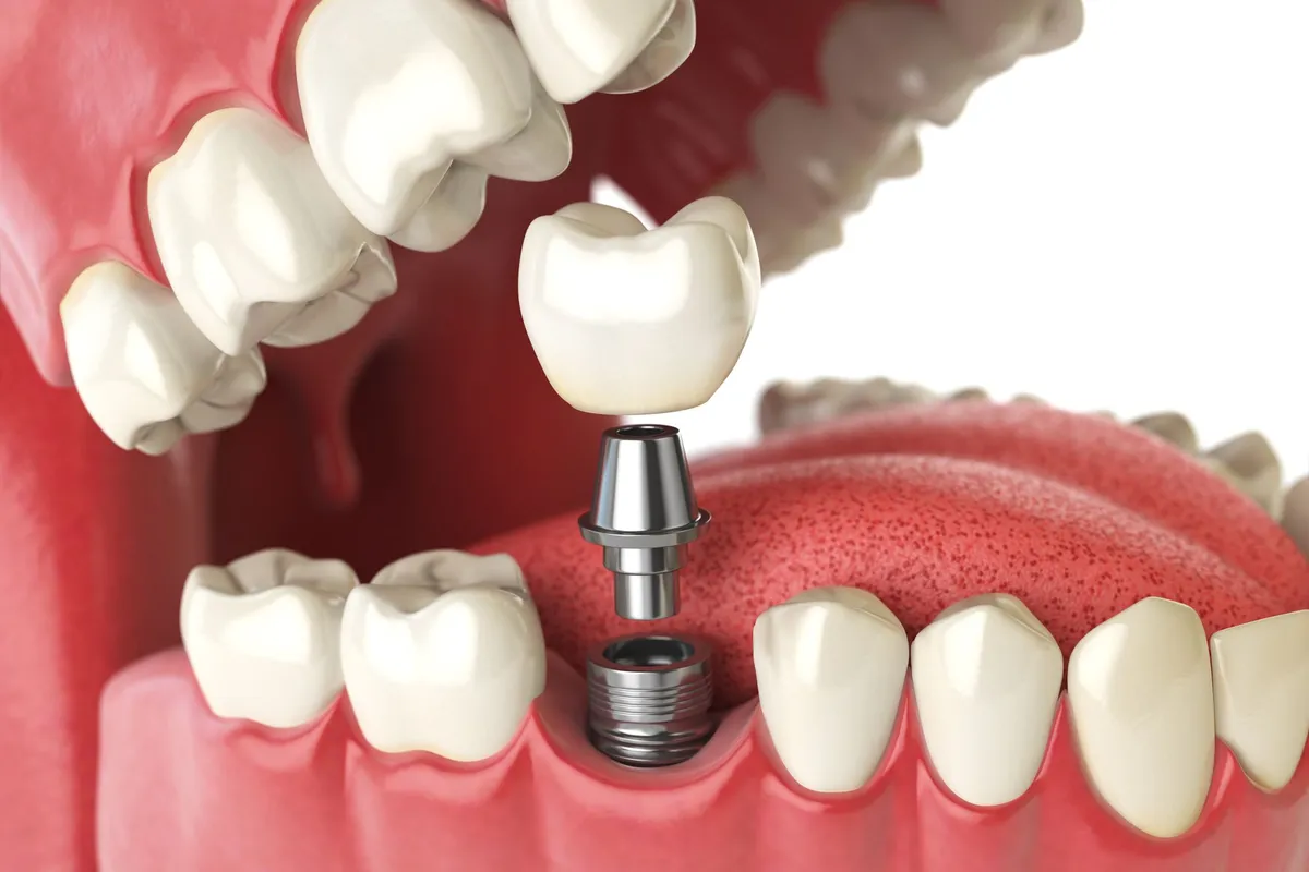 Illustration of an implant-supported dental crown