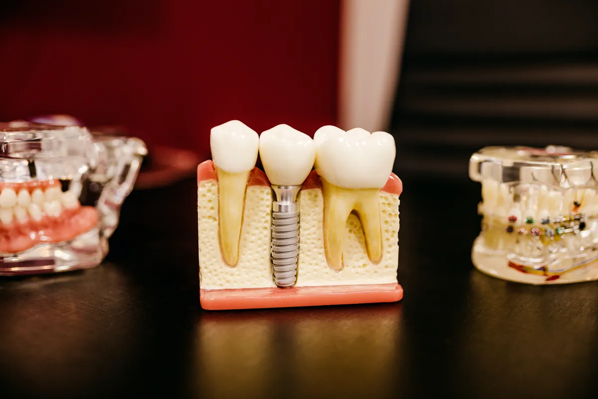 Illustrative smile-design planning lines over a smile